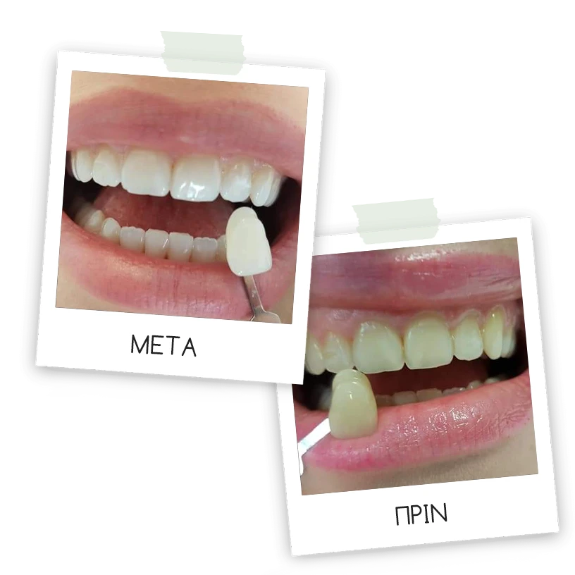 Λευκανση δοντιων